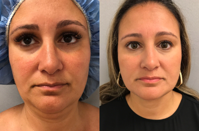 25-34 year old woman treated with Chin Liposuction - 40 y/o who underwent SmartLipo (laser assisted liposuction) of the neck in our office OR under sedation.