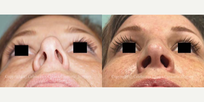 Woman treated with Septoplasty - Woman treated with Rhinoplasty and Septoplasty through a closed technique. Patient is shown before and 2 weeks post-op.