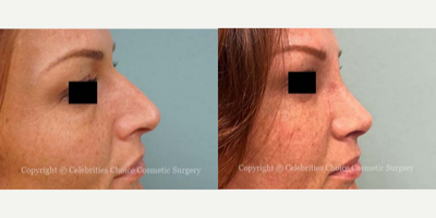 Woman treated with Septoplasty - Woman treated with Rhinoplasty and Septoplasty through a closed technique. Patient is shown before and 2 weeks post-op.