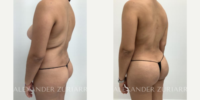 31 year old woman treated with Brazilian Butt Lift - 31 year old woman treated with Brazilian Butt Lift