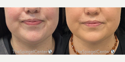 45-54 year old woman treated with Nonsurgical Neck Lift - 45-54 year old woman treated with Nonsurgical Neck Lift