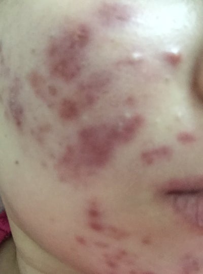 acne gets worse with accutane