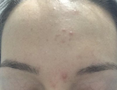 acne adult sudden acne adult sudden