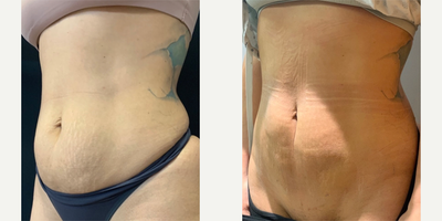 35-44 year old woman treated with Laser Liposuction - Power Assisted Liposuction Abdomen, Outer Thighs