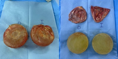 25-34 year old woman treated with Breast Implant Removal, Capsular Contracture Treatment - This female patient, with saggy breast and poor breast projection. Dr. Valdez performed a breast lift with round breast implants. She improve her breast projection, shape and self confidence.