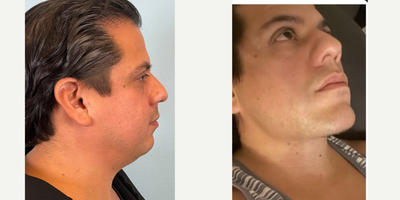 35-44 year old man treated with Buccal Fat Removal, Jawline Sculpting, Morpheus8, Radiesse - Buccal Fat Removal, Jawline Sculpting, Morpheus8, Radiesse