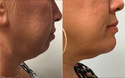 35-44 year old woman treated with Chin Implant - Chin Implant and Liposuction of the Neck