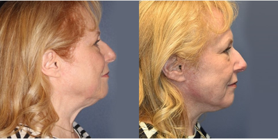 Woman treated with Facelift - Woman treated with Facelift