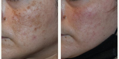 Remove sun damage and melasma with lasers, Los Angeles - Sometimes medium skin tones can be tricky. It is melasma or sun damage? Perhaps a little bit of both. The good news is we have a solution for both conditions - lasers and hydroquinone!