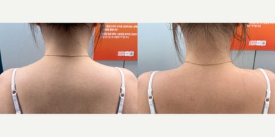 35-44 year old woman treated with Lipodissolve - Fat-dissolving injections to contour the shoulder line