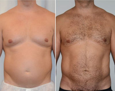 35-44 y.o. man treated with BodyTite Liposuction, chest, abdomen, love handles - This gentleman had areas of stubborn fat despite an active lifestyle. BodyTite liposuction was used to reduce the chest, abdomen, and love handles. Light abdominal etching was performed to enhance muscle definition but still maintain a natural final result.