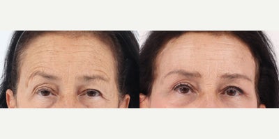 65-74 year old woman treated with Brow Lift, Eyelid Surgery, Facelift, Neck Lift, Facial Fat Transfer, Laser Resurfacing - Patient in her 60's 1 month after a Facelift, Neck lift, Facial Fat Transfer, Temporal Brow Lift, Upper Eyelid Blepharoplasty and co2 laser.