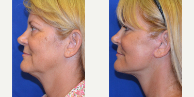 45-54 year old woman treated with Laser Treatment - This patient came in wanting to look as young as she feels. Wanting a natural-looking result, she reached out to Dr. Ho for more information on how to improve her appearance. She elected to have a face/neck lift, fat transfer and laser skin resurfacing procedure.
