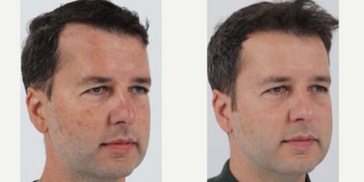 45-54 year old man treated with BroadBand Light (BBL) - Before and after 1 BBL treatment to address sun damage and uneven skin tone. Patient will receive two more treatments.