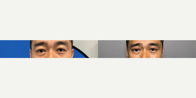 35-44 year old man treated with Eyelid Surgery - Bilateral upper blepharoplasty.