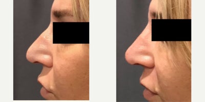 35-44 year old gender nonconforming person treated with Nonsurgical Nose Job - nose filler