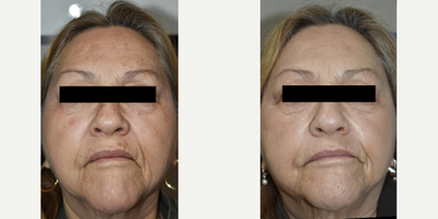 Laser age spot removal for Hispanic skin. - Patient was very self conscious about her age spots but thought that Hispanic skin could not be treated with lasers. At Celibre Medical, regardless of your skin type, we have a laser for you.