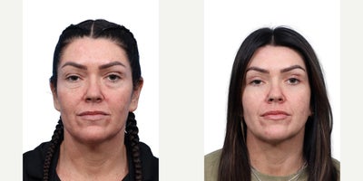 40 year old woman treated with Eyelid Surgery, CO2 Laser - This 40-year-old female was concerned with aging eyes, including excess skin, fine lines, and sun damage. She underwent upper and lower blepharoplasty along with full-face CO laser treatment, resulting in a smoother, rejuvenated, and more refreshed appearance.