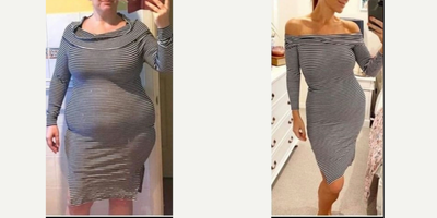 25-34 year old woman treated with Gastric Bypass - Achieving ideal body weight with Gastric bypass surgery. What a succes