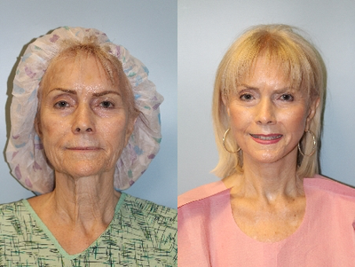 Woman treated with Facelift - Facelift performed by Dr. Bryson Richards. She also had facial skin resurfacing with fractionated erbium.