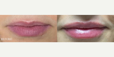 Woman treated with Lip Fillers - Woman treated with Lip Fillers
