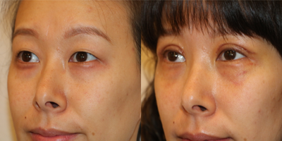 25-34 year old woman treated with Double Eyelid Surgery - This pleasant Vietnamese patient desired a double eyelid fold procedure. She also complained of fullness to her upper eyelids. She underwent a double eyelid fold surgery via the open method with eyelid fat pad modification. She is seen here one week following surgery. The sutures were just removed.