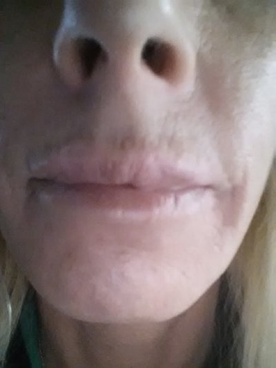 I have nerves exposed on upper lip causing pain and deformation. I have