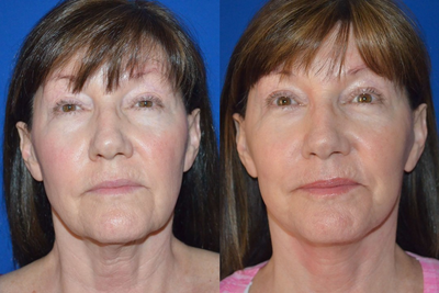 Over 60 year old woman treated with Facelift - Over 60 year old woman treated with Facelift