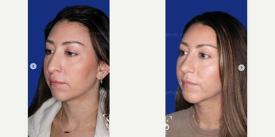 35-44 year old woman treated with Revision Rhinoplasty, Chin Implant - 35-44 year old woman treated with Revision Rhinoplasty, Chin Implant