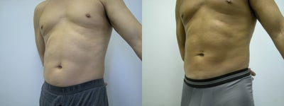 Man treated with Liposuction - Man treated with Liposuction through tiny incisions in inconspicuous spots. A solution is injected (tumescent approach) to facilitate fat removal and minimize bruising. Ultrasonic treatment (Liposelection) was also done where liquefied fat was removed.