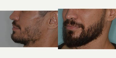 35-44 year old man treated with Beard Transplant, FUE Hair Transplant - Before and after 1800 FUE to beard