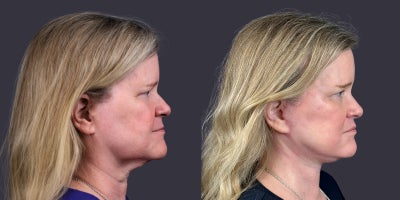 55-64 year old woman treated with ActiveFX, Brow Lift, Facelift, Laser Resurfacing, Lower Facelift, Neck Lift, SMAS Facelift - 56 year old who presented for facial rejuvenation. She is 5'5 and 158 pounds. She had a brow lift, lower face and neck lift, as well as central face CO2 laser skin resurfacing.