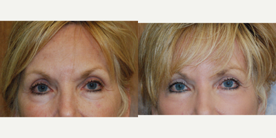 55-64 year old woman treated with J-Plasma Laser Resurfacing - J-Plasma
