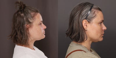 35-44 year old woman treated with Moxi Laser - Moxi Laser Treatments, 5 sessions with Katherine. 2 years post treatment, Age 39.