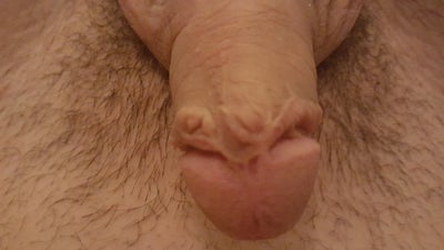 Scar On My Penis 117