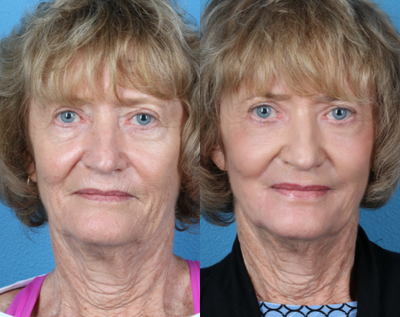65-74 year old woman treated with Renuvion - Patient underwent full face skin resurfacing with Renuvion, the delivery of helium plasma to address fine lines, deep lines, skin laxity and imperfections.