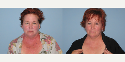 45-54 year old woman treated with BroadBand Light (BBL) - This patient had a BBL laser treatment on her face, neck, and decollete.