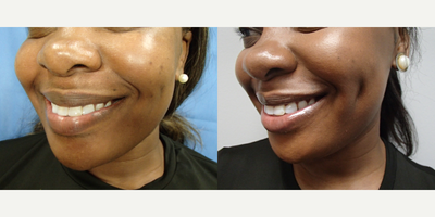 35-44 year old woman treated with Dimple Surgery - Timeless Dimple, Dimple Creation