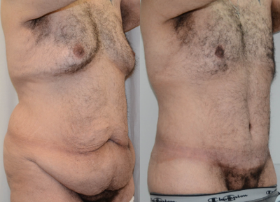 35-44 y.o man recieved circumferential Body Lift, lipo contouring, BodyTite lipo to breasts + chest - This gentleman successfully lost over 100 pounds due to lifestyle changes. While his weight and overall shape were dramatically improved, he was left with areas of stubborn fat as well as loose, hanging skin folds in the multiple body areas. A conventional tummy tuck was inadequate to treat his lower torso, instead requiring a full, circumferential body lift to lift and tighten the front, sides, and back/buttock areas. Additional liposuction contouring was performed to reduce the lower back and love handle region. He was not interested in skin excision to tighten the chest. Instead this area was reduced and tightened with radiofrequency-assisted liposuction contouring (BodyTite).