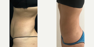 Woman treated with CoolTone - Woman treated with CoolTone