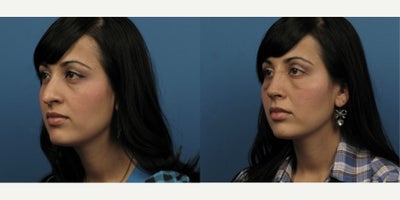 Woman treated with Rhinoplasty - Woman treated with Rhinoplasty
