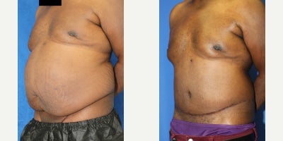 Abdominoplasty / Tummy Tuck Helps Male Patient Achieve a Flatter Midsection - Excess abdominal skin and fat can affect the overall appearance of the torso, especially when the lower abdomen hangs, creating an uneven contour. Our patient is a 54-year-old Black male who visited Dr. Katzen because he was concerned about the extra tissue around his abdomen. Dr. Katzen recommended a tummy tuck, also known as an abdominoplasty, to remove the excess skin and fat and improve the shape of his midsection. He was placed under general anesthesia for the procedure. During surgery, Dr. Katzen removed the hanging lower abdominal tissue and tightened the abdomen to create a smoother, flatter contour. An abdominoplasty can help patients with abdominal skin laxity, lower belly overhang, and fullness that make the stomach look less defined. Photos were taken 4 months after surgery, and our patient achieved remarkable results. His abdomen now appears flatter, smoother, and more balanced with the rest of his body. This case demonstrates how male tummy tuck surgery can improve the lower abdomen, waistline, and overall torso shape through a customized body contouring approach. Dr. Katzens approach focused on removing the extra tissue while keeping the result proportional to his body. The procedure helped reduce the lower abdominal fold, improve the waistline, and create a more structured abdominal profile that better matched his overall frame. His early healing shows a cleaner shape. The final contour looks more balanced.