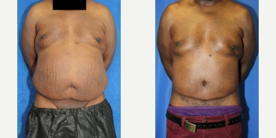 Abdominoplasty / Tummy Tuck Helps Male Patient Achieve a Flatter Midsection - Excess abdominal skin and fat can affect the overall appearance of the torso, especially when the lower abdomen hangs, creating an uneven contour. Our patient is a 54-year-old Black male who visited Dr. Katzen because he was concerned about the extra tissue around his abdomen. Dr. Katzen recommended a tummy tuck, also known as an abdominoplasty, to remove the excess skin and fat and improve the shape of his midsection. He was placed under general anesthesia for the procedure. During surgery, Dr. Katzen removed the hanging lower abdominal tissue and tightened the abdomen to create a smoother, flatter contour. An abdominoplasty can help patients with abdominal skin laxity, lower belly overhang, and fullness that make the stomach look less defined. Photos were taken 4 months after surgery, and our patient achieved remarkable results. His abdomen now appears flatter, smoother, and more balanced with the rest of his body. This case demonstrates how male tummy tuck surgery can improve the lower abdomen, waistline, and overall torso shape through a customized body contouring approach. Dr. Katzens approach focused on removing the extra tissue while keeping the result proportional to his body. The procedure helped reduce the lower abdominal fold, improve the waistline, and create a more structured abdominal profile that better matched his overall frame. His early healing shows a cleaner shape. The final contour looks more balanced.