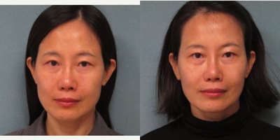 Silhouette InstaLift Sutures - Silhouette Instalift Sutures before and after 6 months