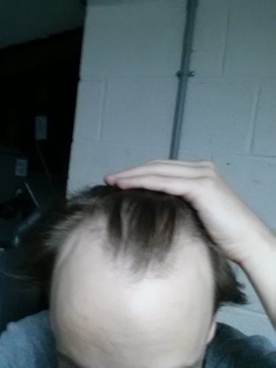 Best option for hair loss