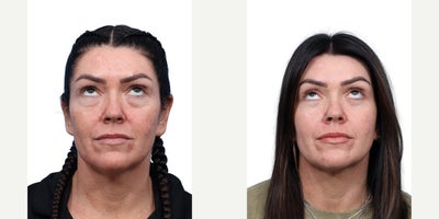 40 year old woman treated with Eyelid Surgery, CO2 Laser - This 40-year-old female was concerned with aging eyes, including excess skin, fine lines, and sun damage. She underwent upper and lower blepharoplasty along with full-face CO laser treatment, resulting in a smoother, rejuvenated, and more refreshed appearance.