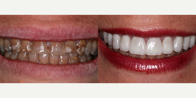 Porcelain Veneers - 47 year-old female presented with severe tetracycline-stained teeth. She developed this condition as a child. Many years ago she had composite material bonded over her teeth to mask the dark stains; most of which had already worn off. Porcelain Laminate Veneers were placed with a total treatment time was 2 weeks.