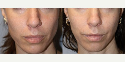 35-44 year old woman treated with Custom XO Vit Micro Skin Infusion - 38 y/o F, G0P0, 54, 120 lbs, XO-Vit Customized Skin Infusion with Exosomes, Vitamins, Minerals