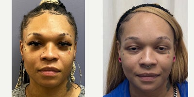 35-44 year old woman treated with Forehead Reduction, Brow Bone Reduction, Brow Lift, Facial Feminization Surgery - This young lady underwent forehead feminization, and chin feminization.