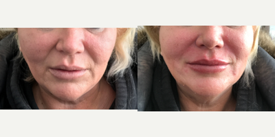 55-64 year old woman treated with Lip Augmentation - Juvederm ultra plus lip injection and Radiesse for marionette lines.